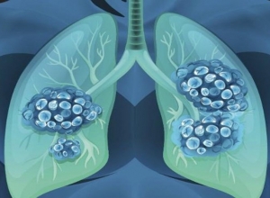 Làm sao để sống chung với bệnh xơ phổi?